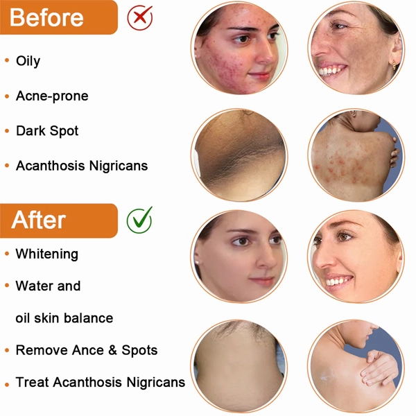 Fivfivgo™ Cleansing Lotion for Acne & Spots & Acanthosis Nigricans