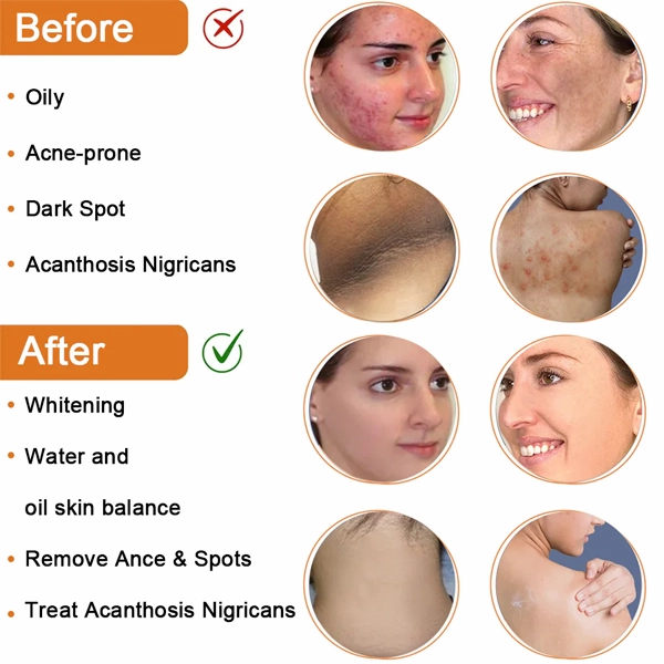 Fivfivgo™ Reinigungslotion für Akne & Pickel & Acanthosis Nigricans