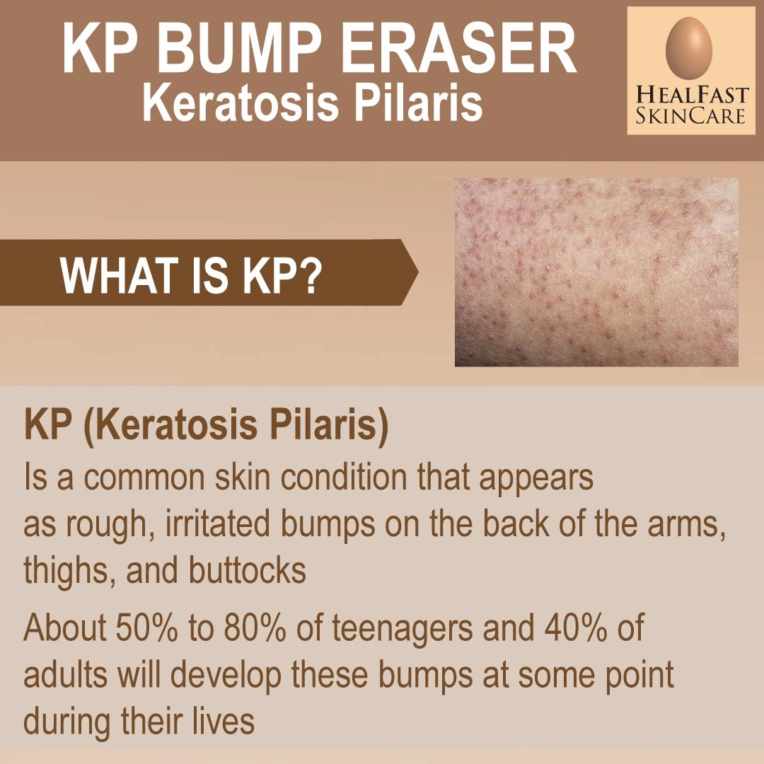 KP Bump Eraser Bodywash – Soften, Exfoliate, Nourish Rough and Bumpy Skin with 3% BHA – Keratosis Pilaris - For All Types – No Scrubbing Required – Fragrance and Paraben Free